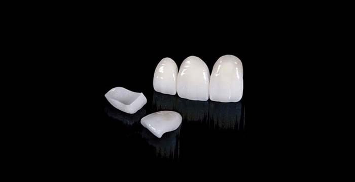 Skyzir E-Max Veneers